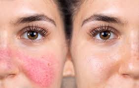 How a laser facial for redness and pores in Torrance Can Help